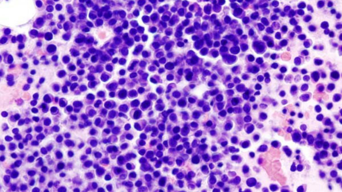 Multiple myeloma 2 HE stain