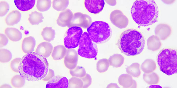 Clinical trial reveals genetic fault that reduces the effectiveness of leukaemia treatment