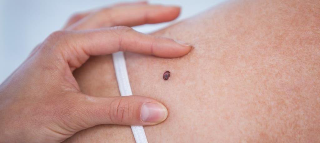 The naked eye alone is not enough to ensure the accurate diagnosis of skin cancer, say experts