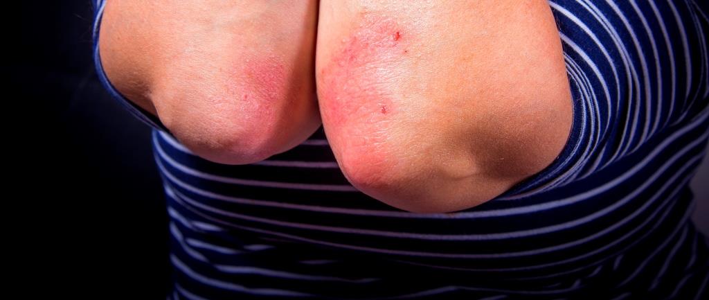 Molecule discovery holds promise for gene therapies for psoriasis