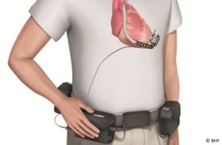 LVAD and carrying case - illustration