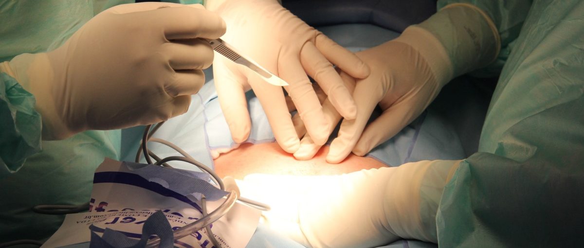Unnecessary appendicectomy rates highest in UK women