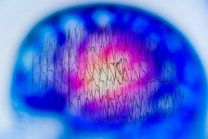 EEG from a patient with epilepsy