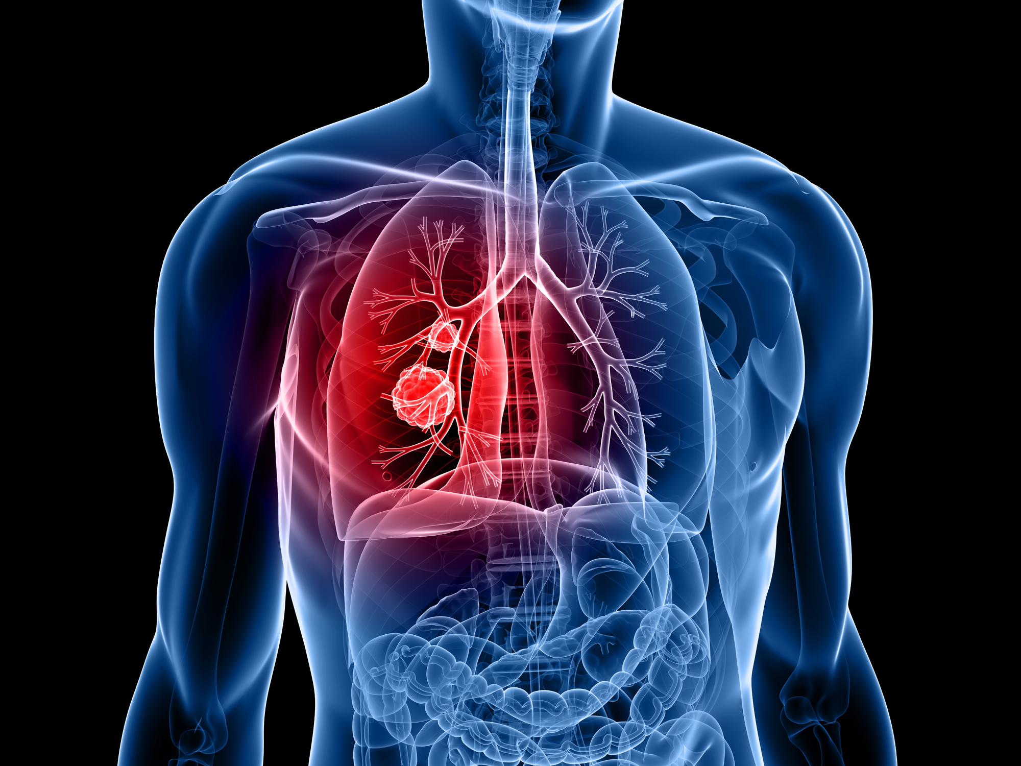 3d rendered image of lung with tumour